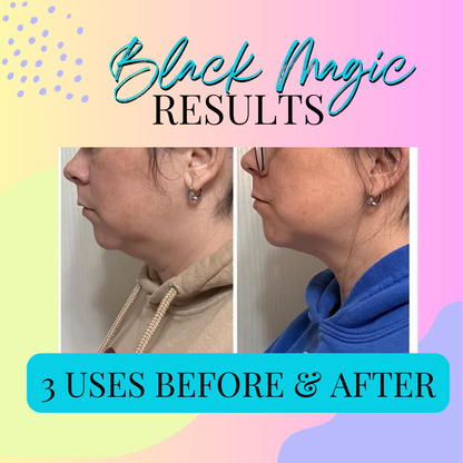Black Magic comparison graphic with two side-profile photos of the lower face